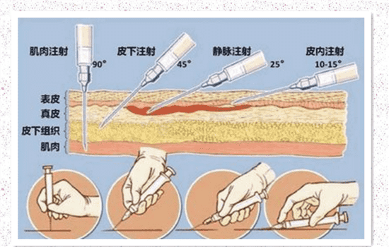 瘦脸针脸僵硬多久消失 瘦脸针笑容僵硬多久好