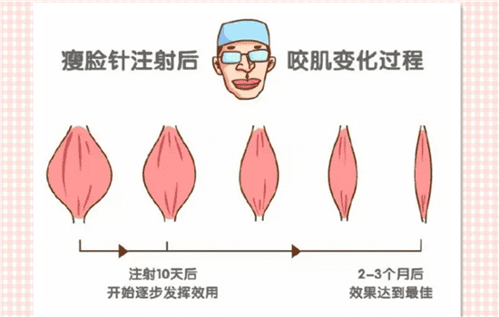 瘦脸针没效果多久补 瘦脸针隔多久打第二针