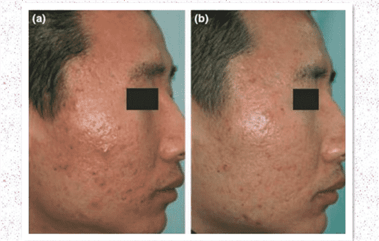 点阵激光去痘印有效吗 点阵激光可以去痘印吗