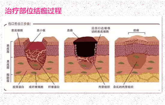 激光去痘印会留疤吗 激光祛痘印会留疤吗