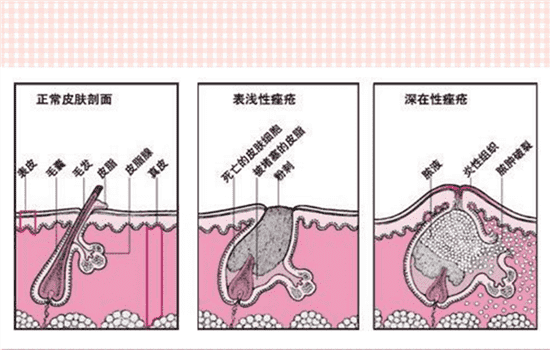 用激光去痘印好吗 激光去痘印到底好不好