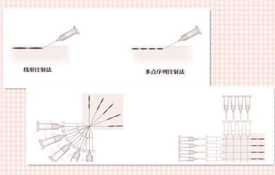 玻尿酸打法令纹打在哪