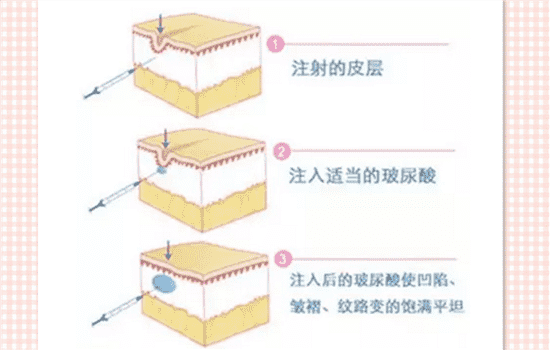 鱼尾纹打玻尿酸管事吗 鱼尾纹可以打玻尿酸吗