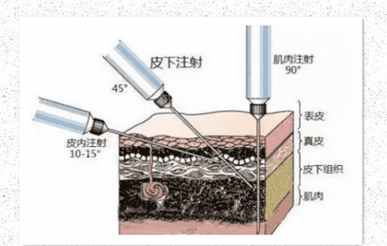 川字纹玻尿酸注射方法
