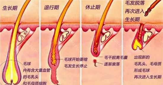 超冰脱毛会复发吗