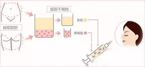 脂肪填充多久擦护肤品 脂肪填充多久可以涂护肤品