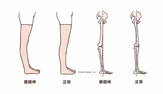 膝盖超伸怎么矫正 膝盖超伸最简单的纠正