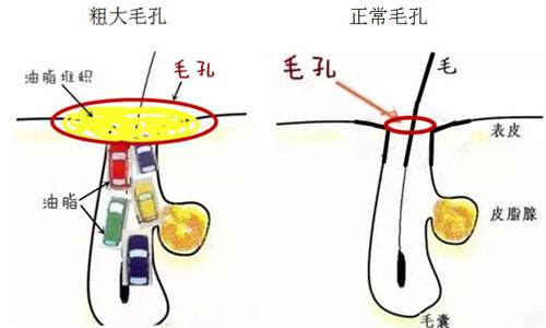 毛细孔粗大怎么办 毛孔粗大如何改善